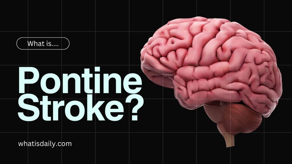 What is a pontine stroke