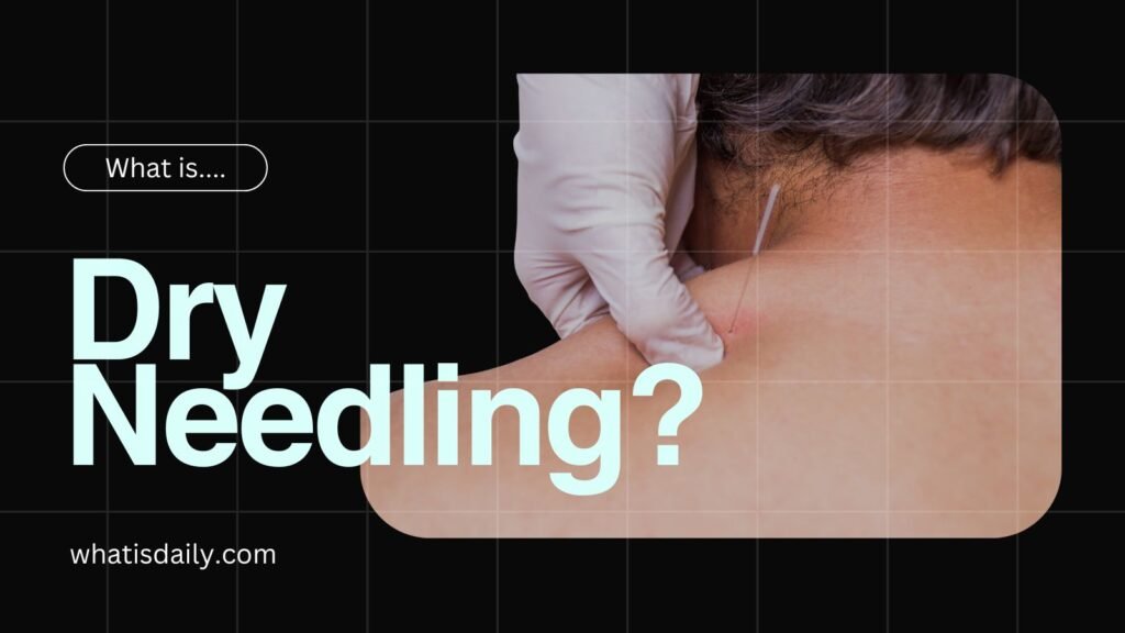 What is dry needling