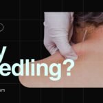 What is dry needling