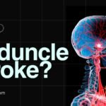 What is Penduncle Stroke